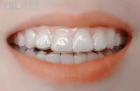 無托槽隱形矯正多少錢？