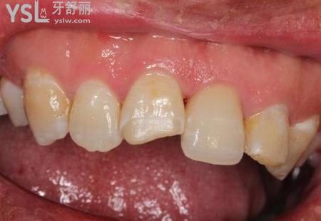 牙齒外傷松動后多久可以？