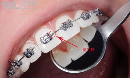 前牙開合的托槽隱形矯治方法是什么？