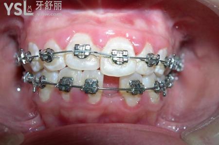 牙套托槽掉多久之內(nèi)必須粘回去？