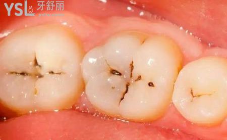 牙齒有黑點是怎么回事？