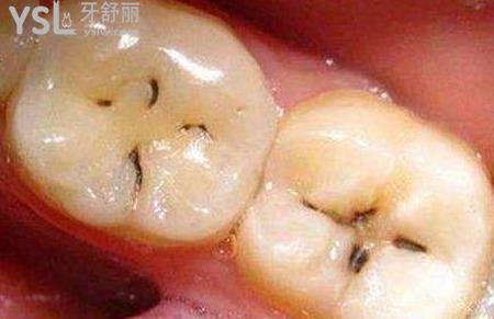 牙齒有黑點(diǎn)怎么辦？