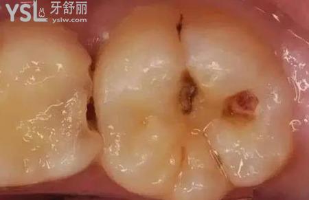 牙齒有黑點(diǎn)怎么治療？