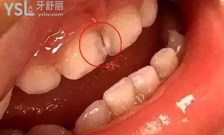 牙齒里面出現(xiàn)黑點(diǎn)是齲齒嗎？