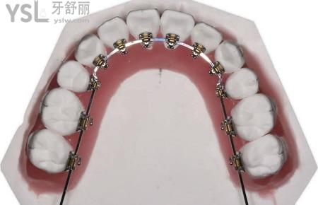直絲弓矯治器的原理是什么？