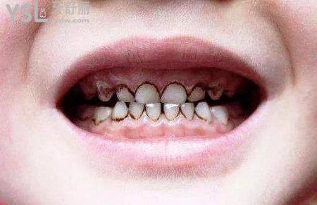 兒童患齲齒是否需要治療？