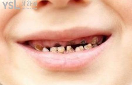 兒童門牙齲齒怎么治療？