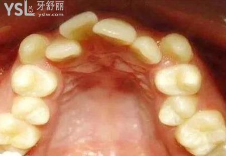 牙齒擁擠怎么造成的？