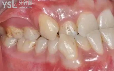 牙齒擁擠怎么矯治？