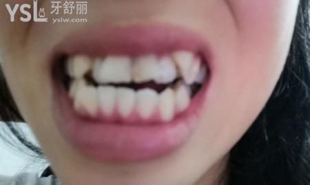 牙齒擁擠有哪些危害？