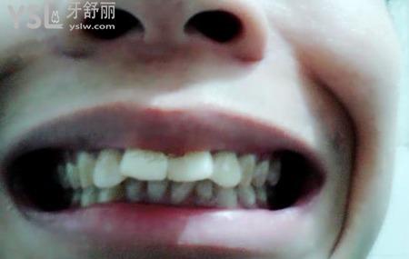 矯正齙牙有什么并發(fā)癥？