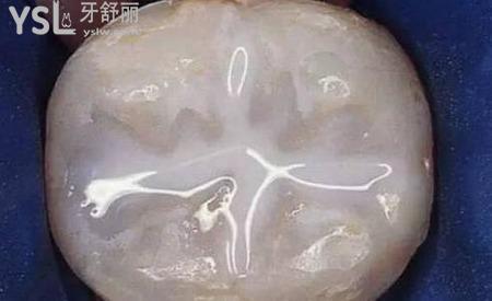 怎么樣才能防止蛀牙？