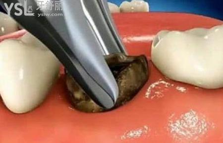 有蛀牙用什么牙膏？