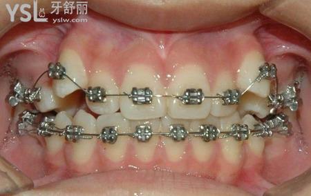 矯正牙齒后怎么刷牙？