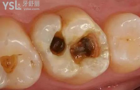 蛀牙中間變黑怎么處理？