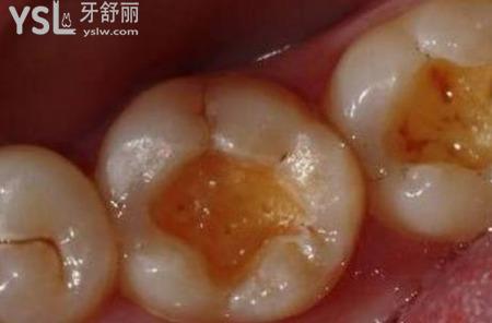 重度蛀牙有什么反應(yīng)？
