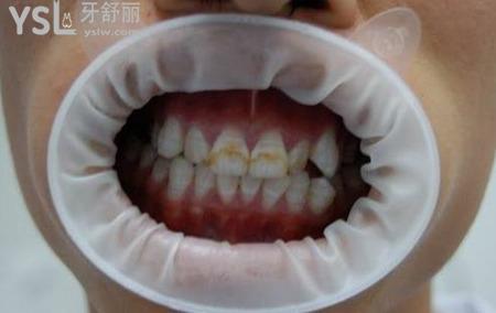 氟斑牙是怎么形成的？