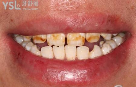 氟斑牙的特點(diǎn)是什么？