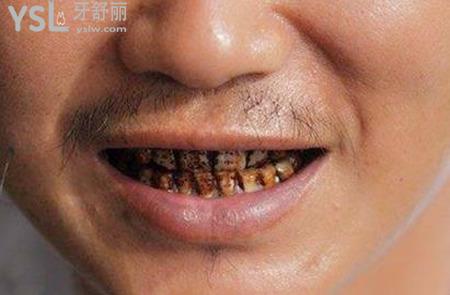 氟斑牙怎么治療？