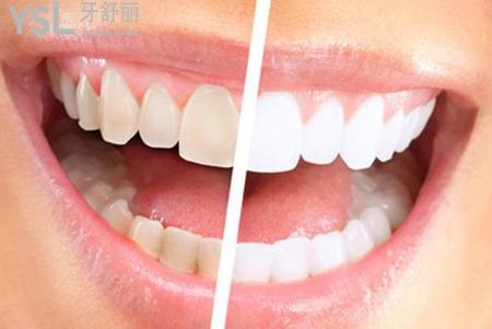 牙齒發(fā)黃怎么辦？