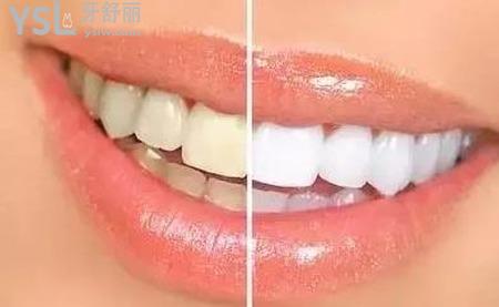 為什么每天刷牙牙齒還是很黃？