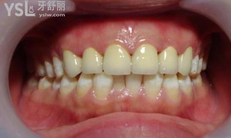 氟斑牙有什么注意事項(xiàng)？