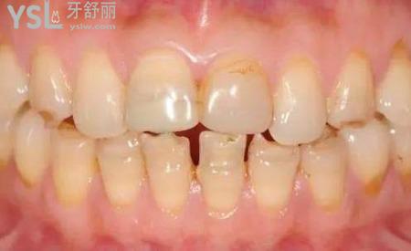 牙齒很黃怎么辦？