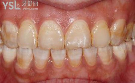 氟斑牙用小蘇打好嗎？