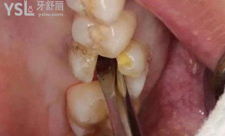 什么樣的是復雜牙？
