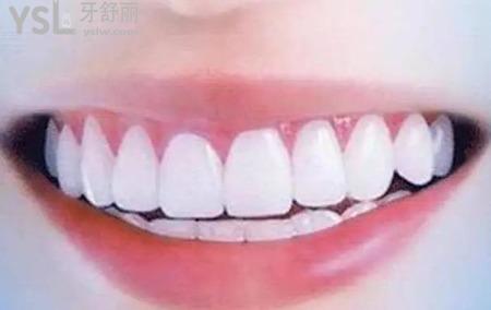 牙性前突和骨性前突的區(qū)別在那？