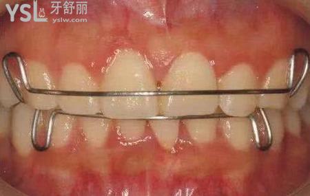 有蛀牙可以矯正嗎？