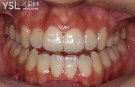 帶隱形牙套牙疼如何緩解？