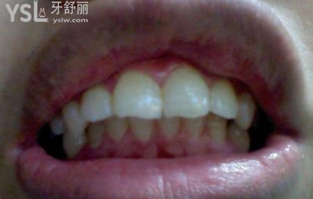 天包地矯正多少錢？