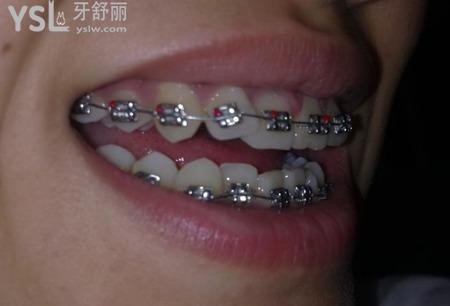 天包地是怎么引起的？