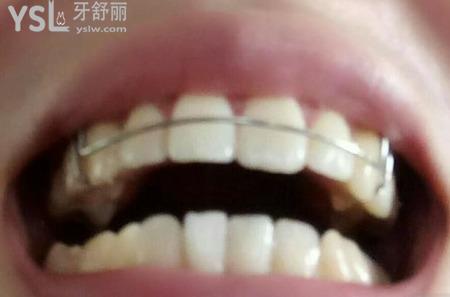 如何矯正凸嘴？