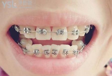 生活中如何矯正凸嘴？