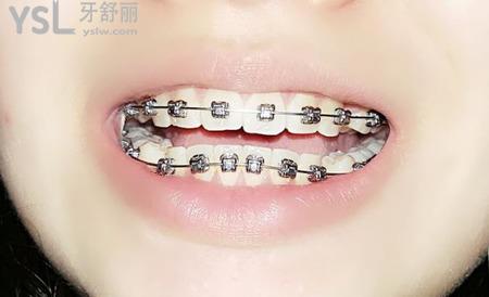 拔牙矯正有后遺癥嗎？