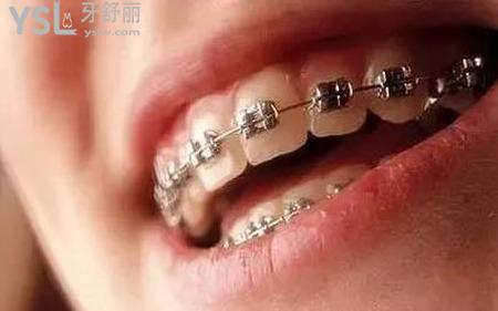 整牙可以不拔牙嗎？