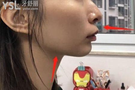 地包天這個時候可以矯正嗎？
