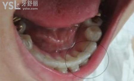 牙根短適不適合戴牙套？