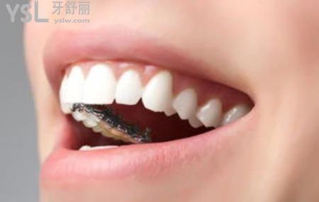 帶牙套的牙齒吃東西疼怎么辦？