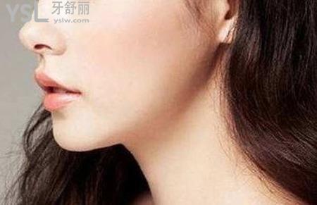 下巴整形要多少費(fèi)用？