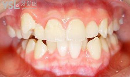 牙齒擁擠的后果是什么？