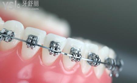 金屬自鎖托槽的優(yōu)點有哪些？