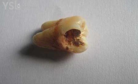 智齒爛了大洞疼得要死怎么辦？