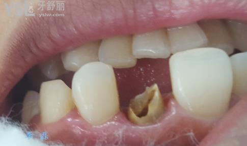 爛牙根十年了很臭怎么辦？