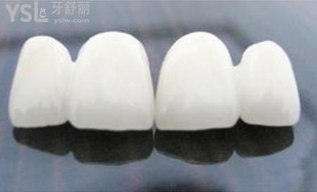 烤瓷牙可以洗牙嗎？