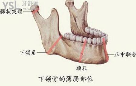 臉部磨骨整形需要多少錢？