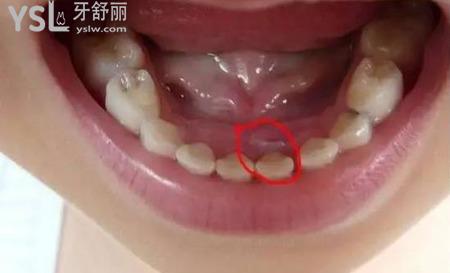 智齒不疼拔不拔？