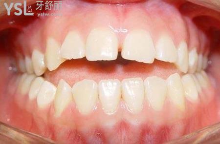 牙齒開合怎樣矯正？